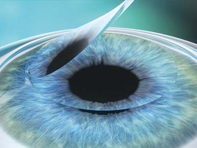 Femto LASIK Laserkorrekturmethode der Fehlsichtigkeit 