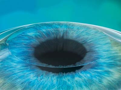 Femto LASIK Laserkorrekturmethode der Fehlsichtigkeit