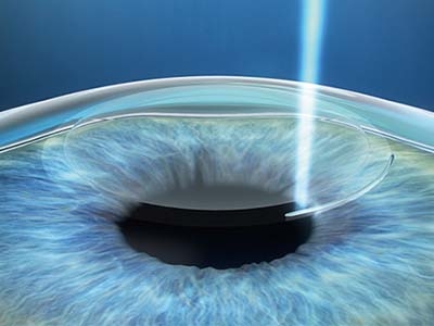 Der Femtosekundenlaser Zeiss Visumax 800 erzeugt in der mittleren Schicht der Hornhaut ein Lentikel.