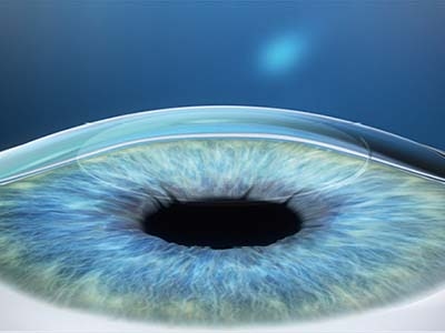 Die Korrektur der optischen Länge der Augenachse behebt die Fehlsichtigkeit und den Astigmatismus.