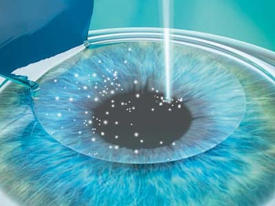 Femto LASIK Laserkorrekturmethode der Fehlsichtigkeit